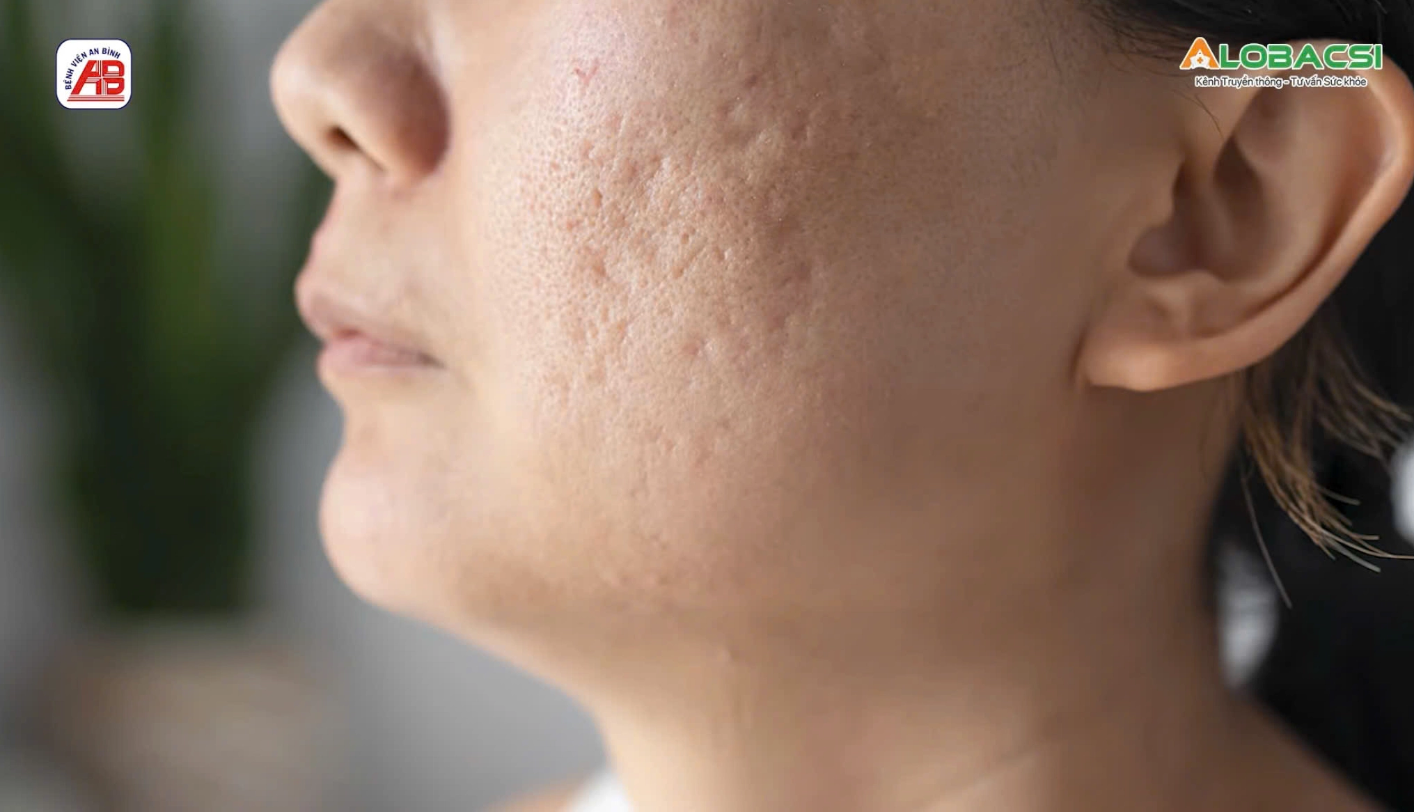 Trị sẹo lõm sau mụn: Khi nào là thời điểm đạt hiệu quả phục hồi cao nhất?